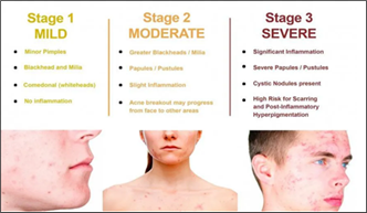 Stages of acne